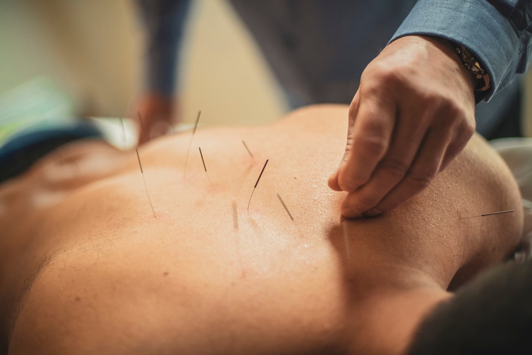 Back acupuncture